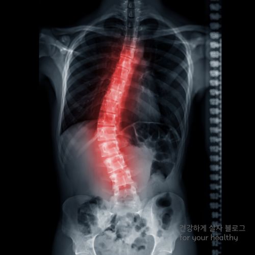 척추측만증 군대