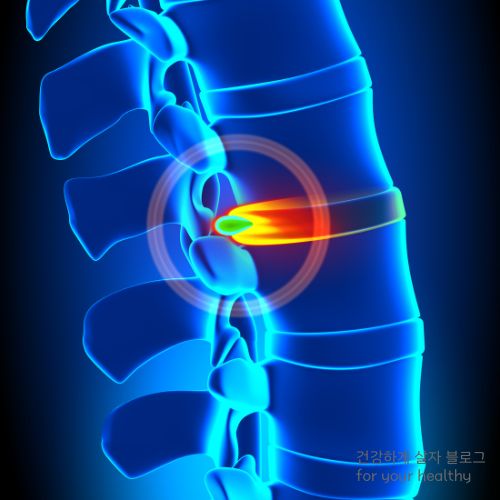 허리디스크 오른쪽 다리저림