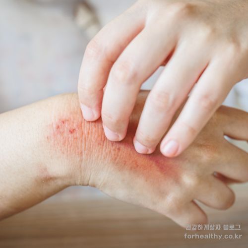 원숭이두창 어떻게 걸리나요?