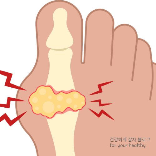 걸을때 발가락 찌릿